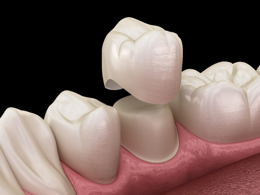 Dental crown premolar tooth assembly process. Medically accurate 3D illustration of human teeth treatment