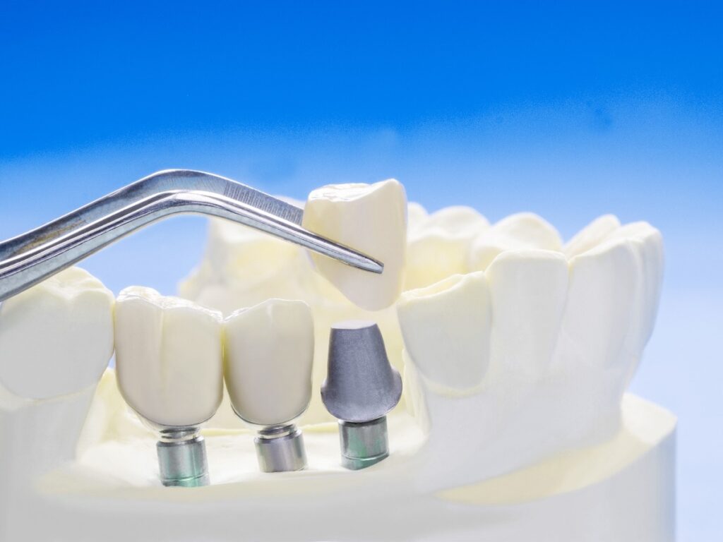 Close up Implan tooth support fix bridge implan and crown.