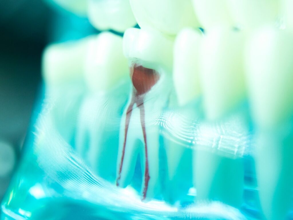 Dental tooth root canal jpg
