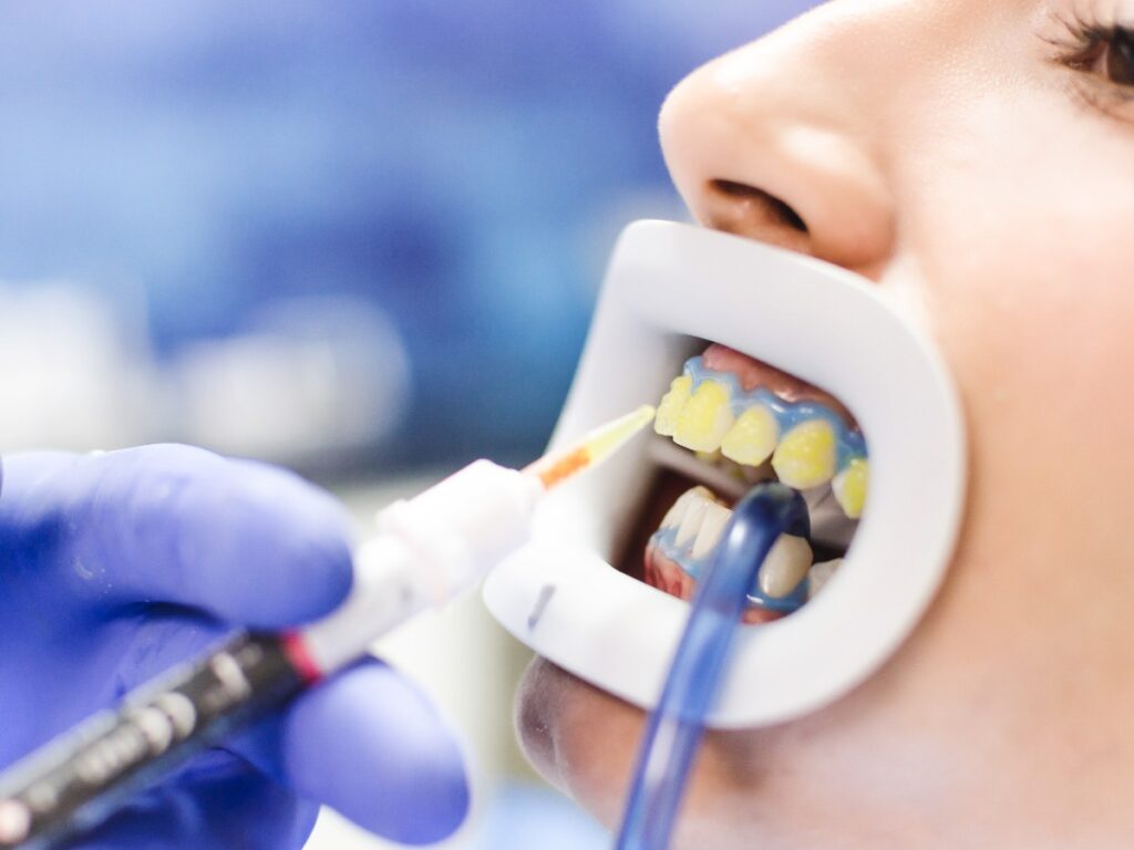 Female patient on teeth bleaching treatment