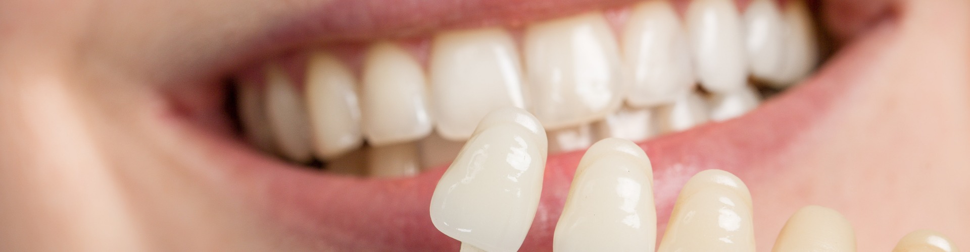 using shade guide at woman's mouth to check veneer of teeth for bleaching