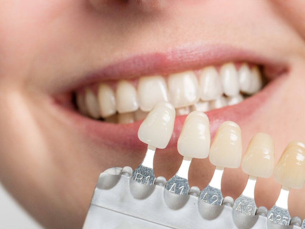 using shade guide at woman's mouth to check veneer of teeth for bleaching