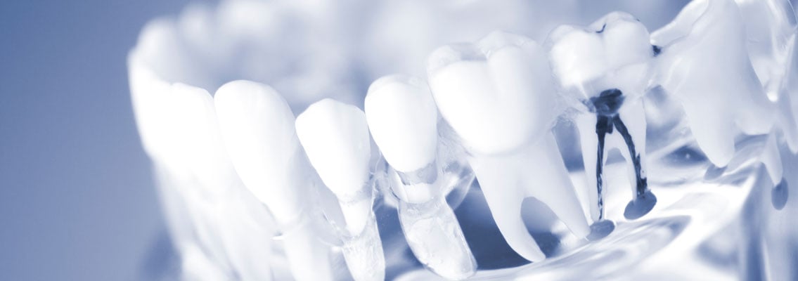 Modell Zahnwurzelbehandlung