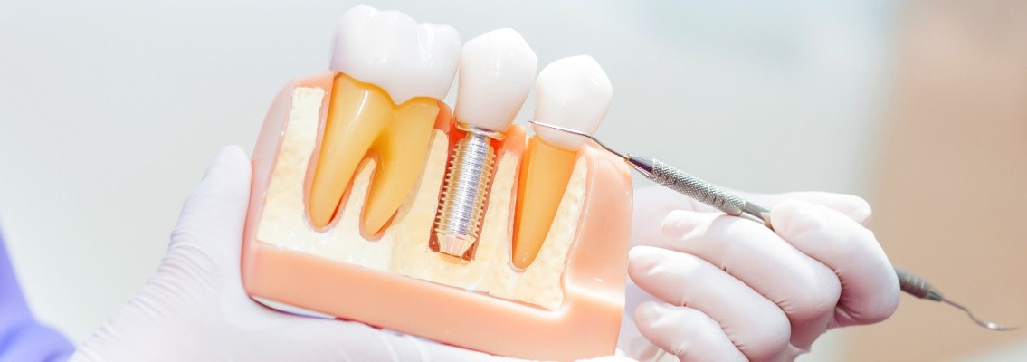 Zahnarzt zeigt Möglichkeiten bei Zahnimplantaten in der Zahnklinik