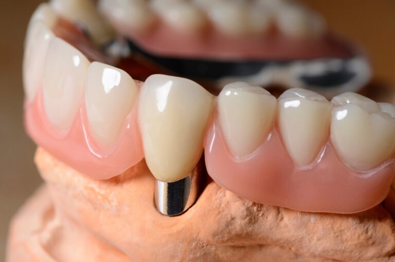 Teleskop Prothese Oberkiefer