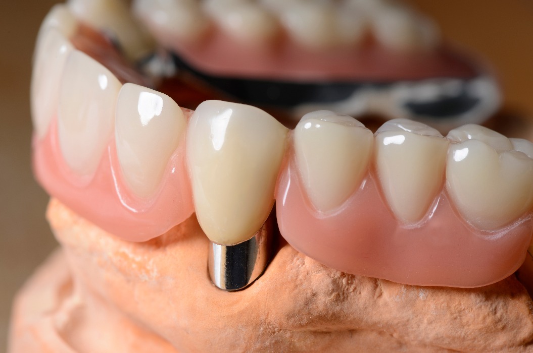 Teleskop Prothese Oberkiefer