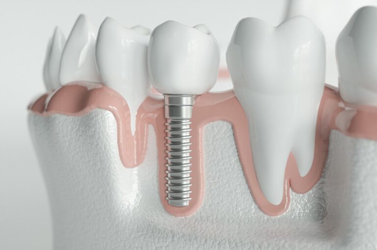 Gesunde Zähne und ein Implantat – 3D-Rendering