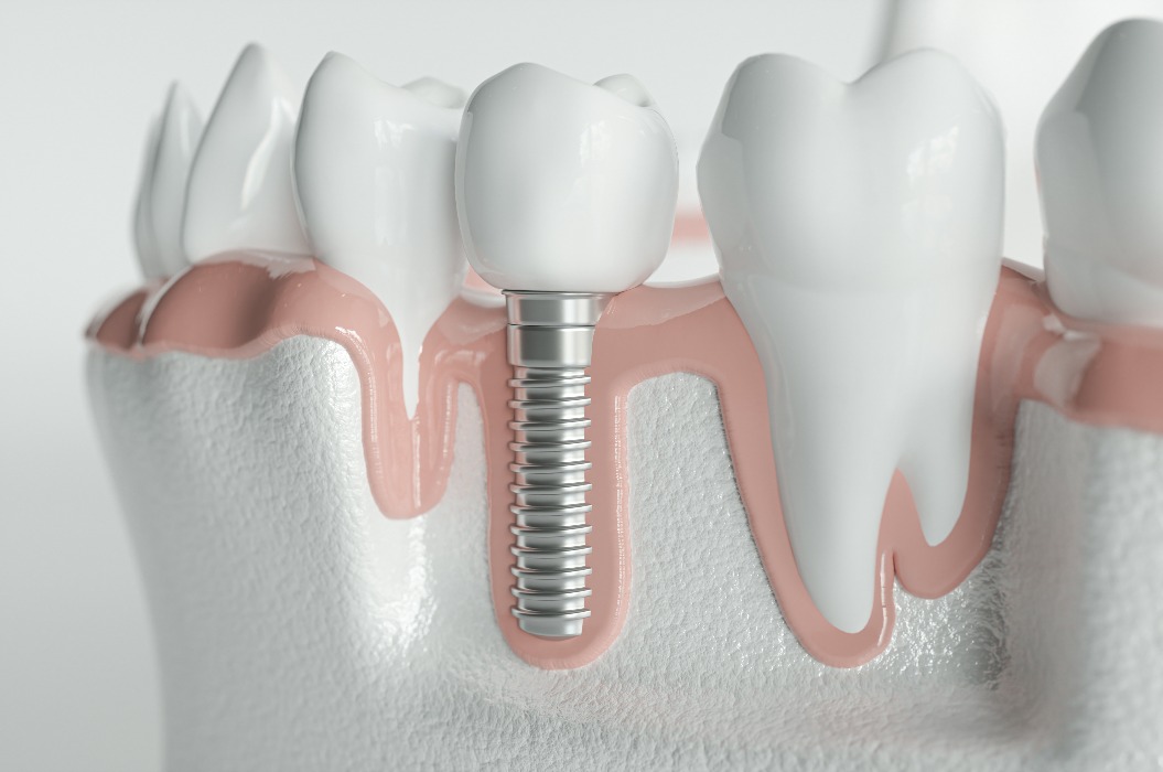 Gesunde Zähne und ein Implantat – 3D-Rendering